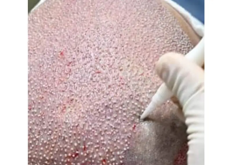 Hair Transplant In Istanbul