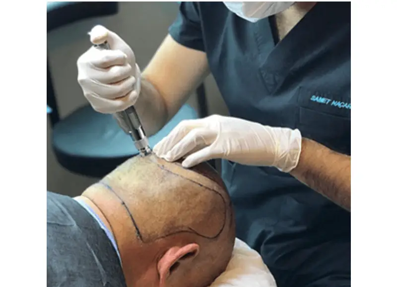 Hair Transplant in Turkey