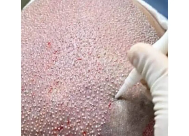 Hair Transplant in Turkey