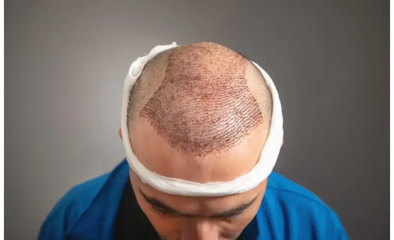 Hair Transplant in Istanbul