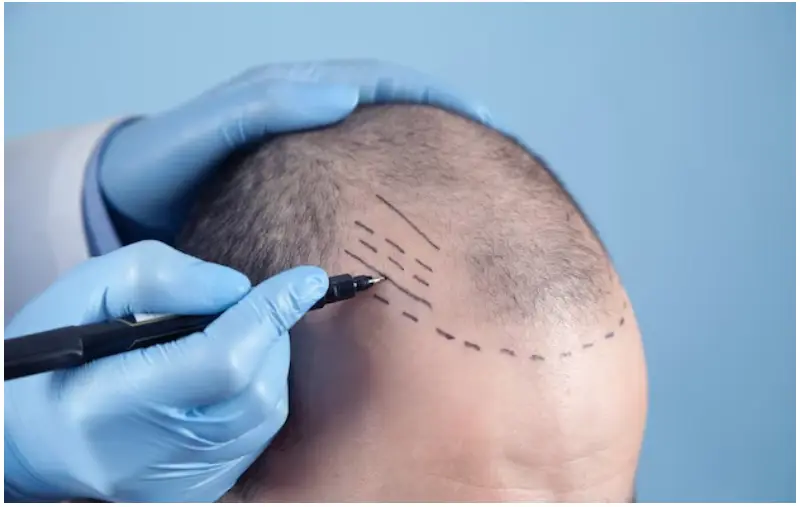 Hair Transplant in Istanbul